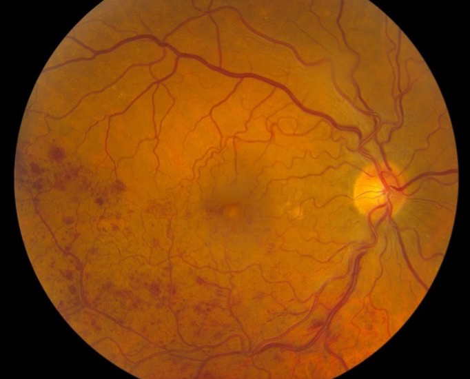 Retinal Vein Occlusion Columbia | What is Retinal Vein Occlusion?